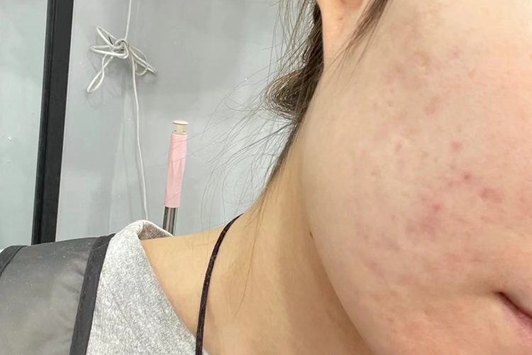 痤疮明显恢复图