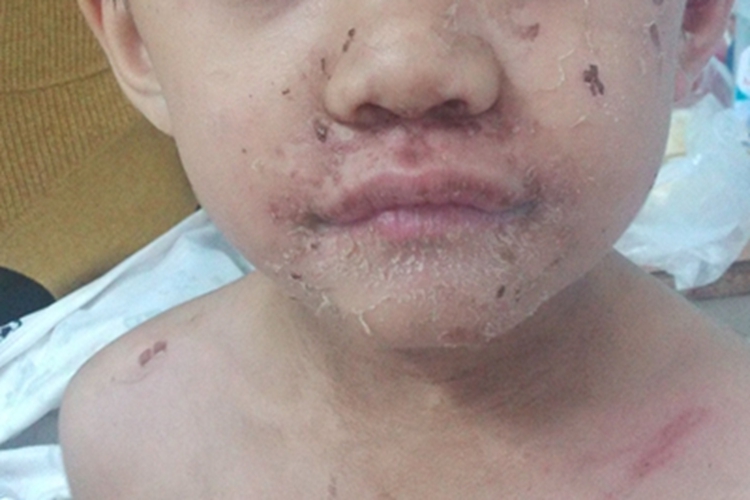 脓疱病口周脱屑图