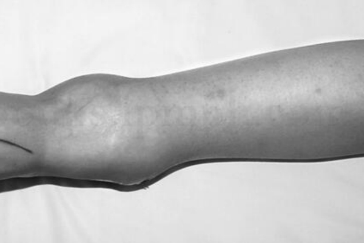 胫骨远端软骨肉瘤图