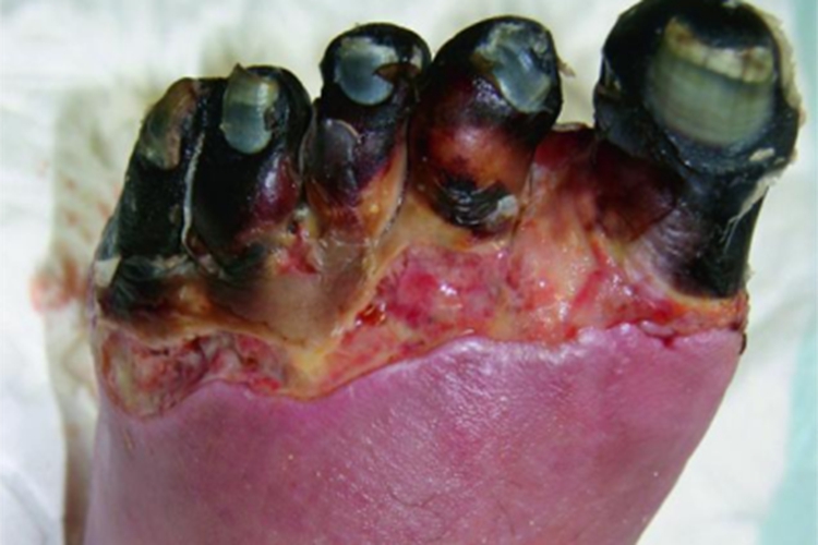 浸渍足脚趾烂了发黑图 浸渍足脚趾烂了发黑图