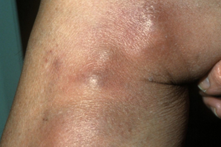 结节性结核性静脉炎硬块图