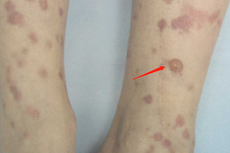 被跳蚤咬了起水疱图