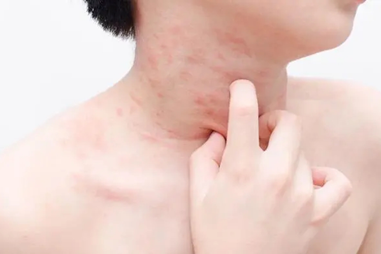 脖子荨麻疹图