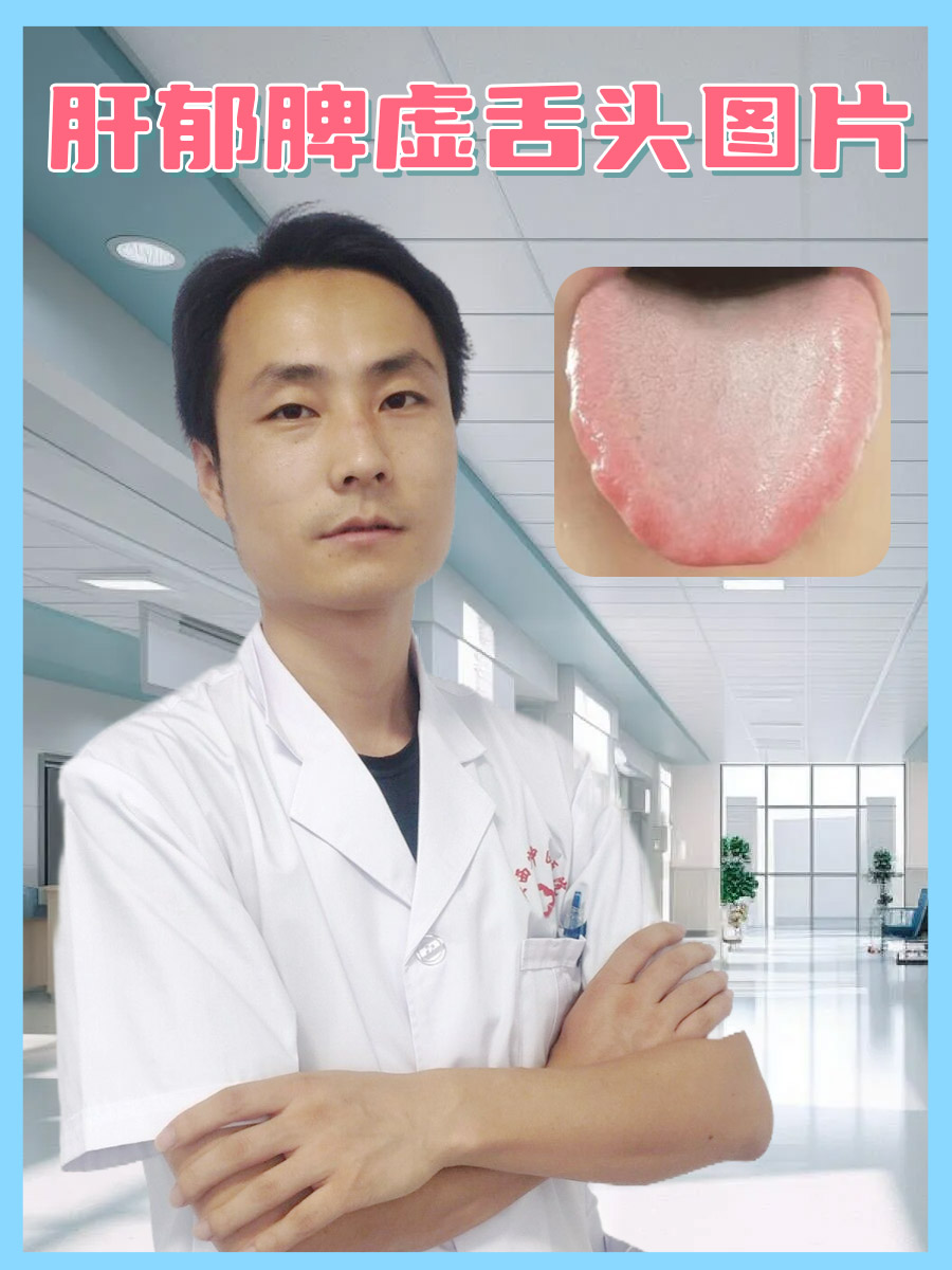 肝郁脾虚舌头图片