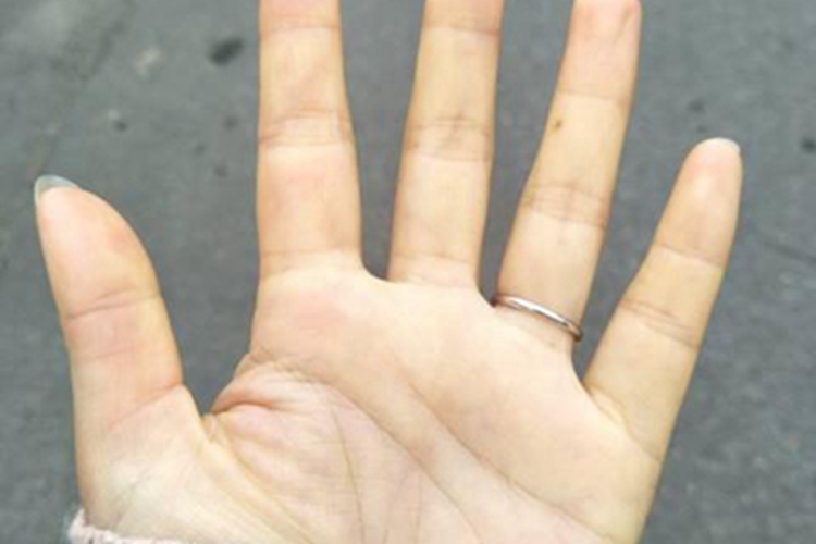 甲状腺功能减退症手掌皮肤发黄图