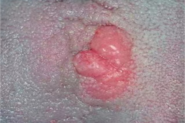 正中菱形舌炎舌头结节图