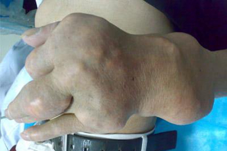 痛风手背上有好多硬块图 痛风手背上有好多硬块图