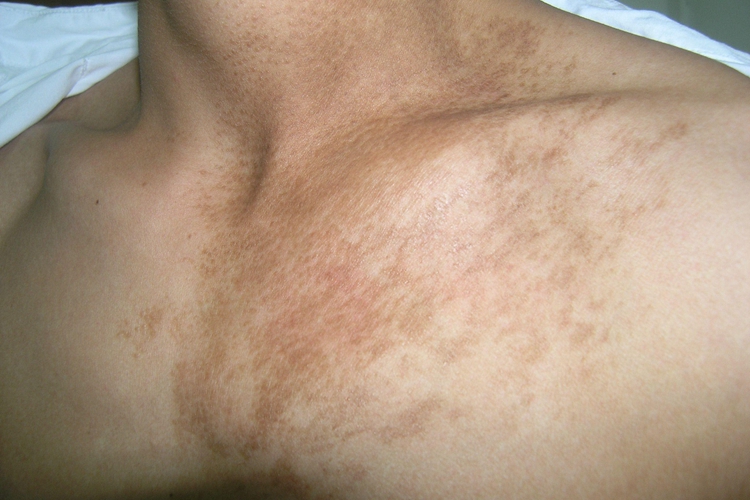 泛发型表皮痣胸部症状图