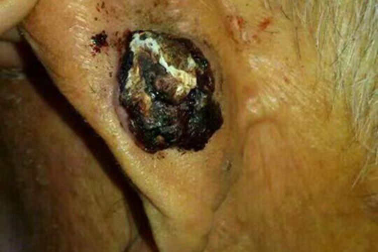 色素型基底细胞癌耳后症状图 色素型基底细胞癌耳后症状图