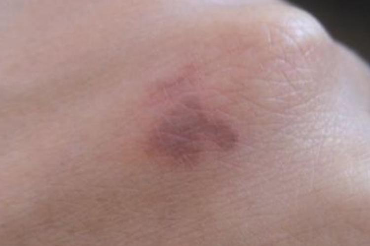 轻微烟头烫伤图 轻微烟头烫伤图