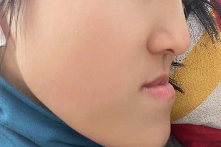 反颌嘴巴内凹图 反颌嘴巴内凹图