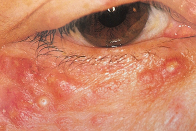 硬结性红斑眼周症状图