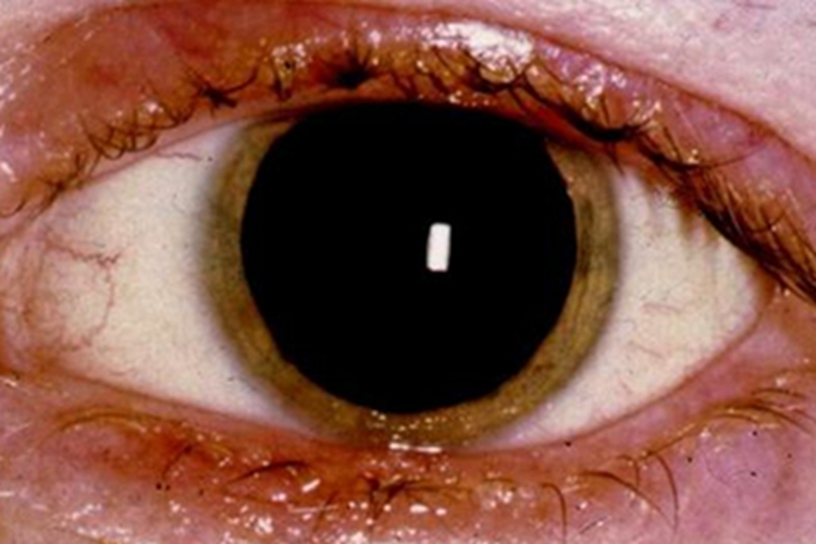 苯中毒瞳孔变形图