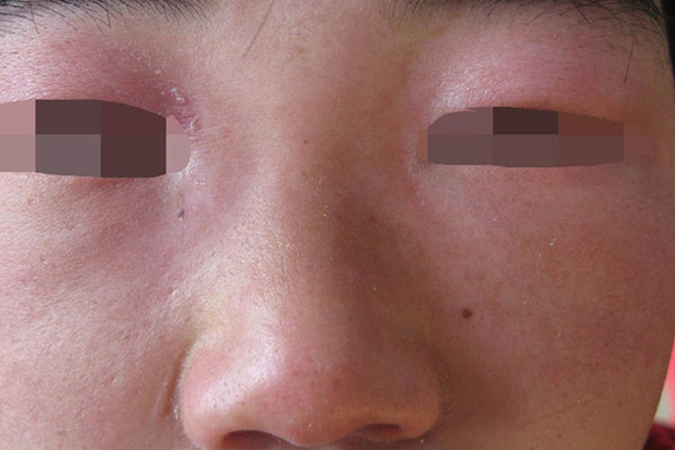 皮肌炎眼睑紫红色斑图 皮肌炎眼睑紫红色斑图