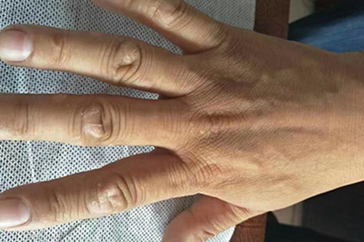 慢性湿疹手指症状图