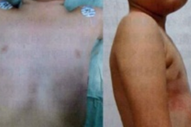 漏斗胸轻微驼背图