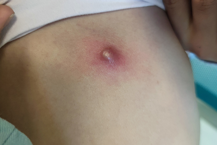 细菌性皮肤感染疖图