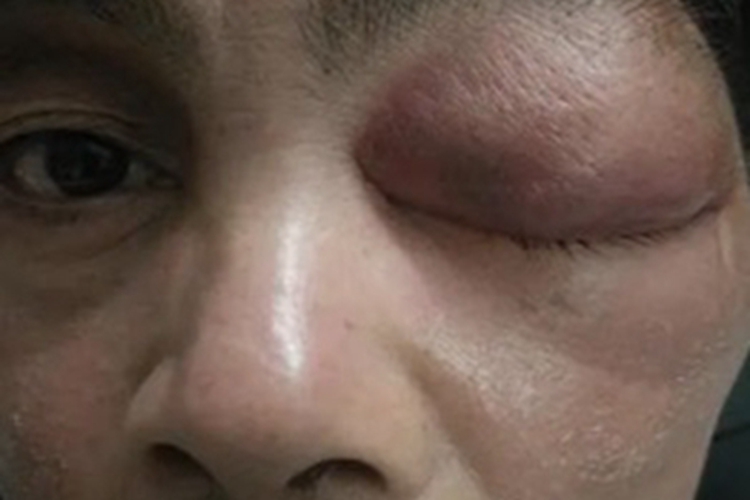 眼眶肿瘤眼部大包图 眼眶肿瘤眼部大包图