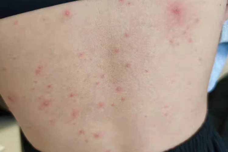 水痘红色丘疹图