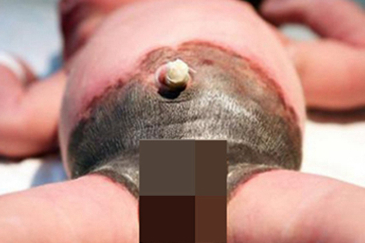 先天性巨痣下腹症状图 先天性巨痣下腹症状图