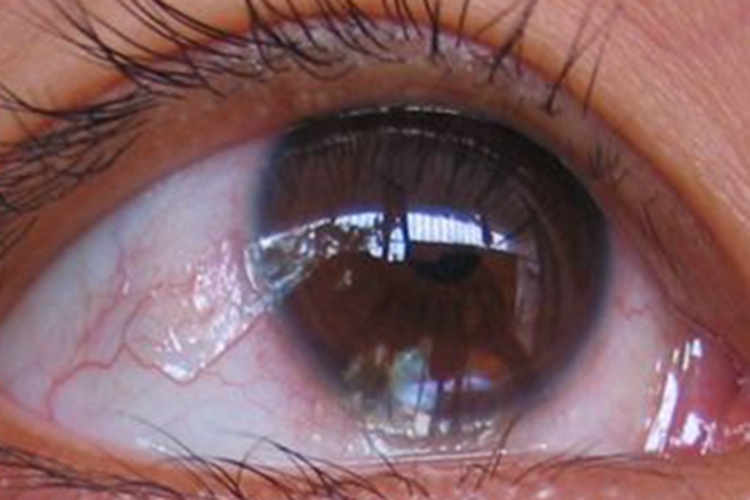 结膜炎眼球症状图 结膜炎眼球症状图