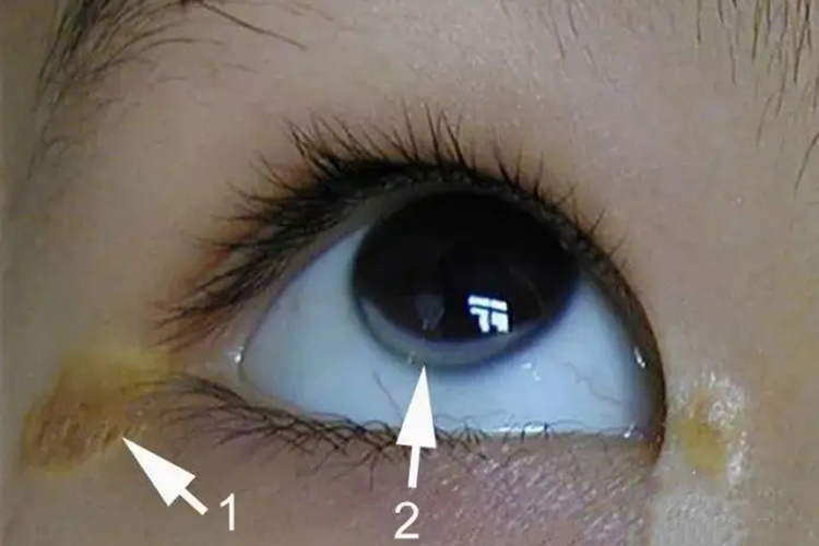 小儿扁平黄瘤图 小儿扁平黄瘤图