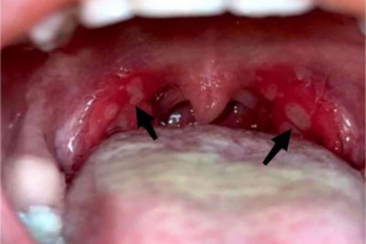 疱疹性咽峡炎溃疡图 疱疹性咽峡炎溃疡图