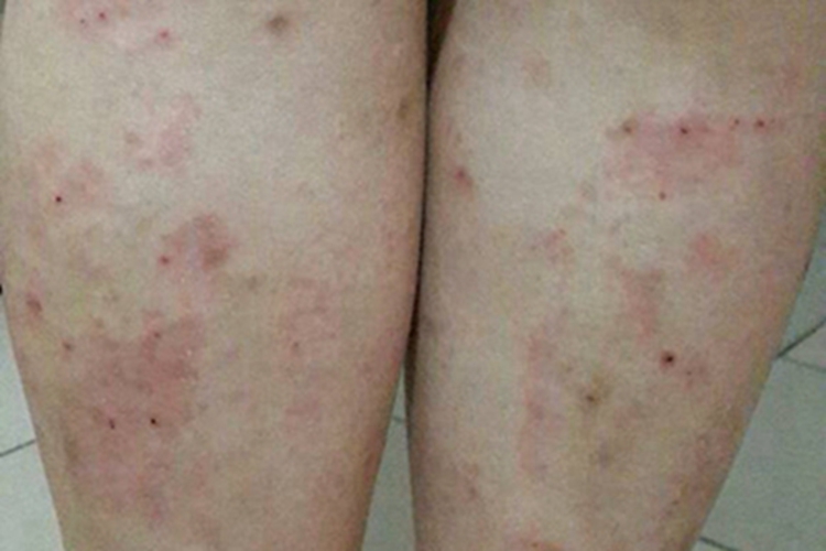 虫咬皮炎小腿血痂图