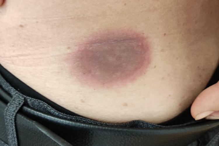 固定型药疹红斑图