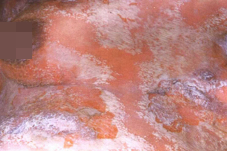 角层下脓疱性皮病脓包图 角层下脓疱性皮病脓包图