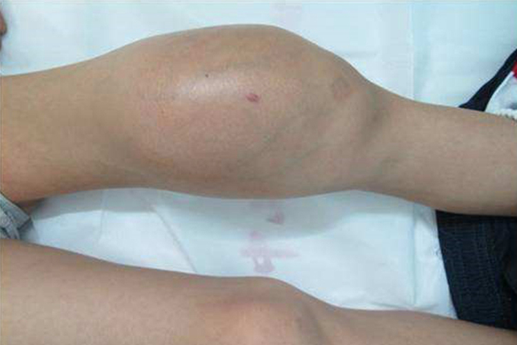 女性骨癌疼膝盖肿块图