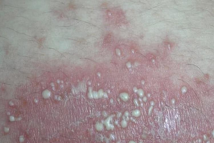 脓疱型银屑病图