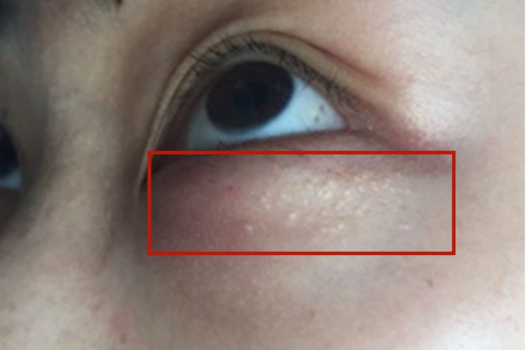 汗腺瘤下眼睑白点图