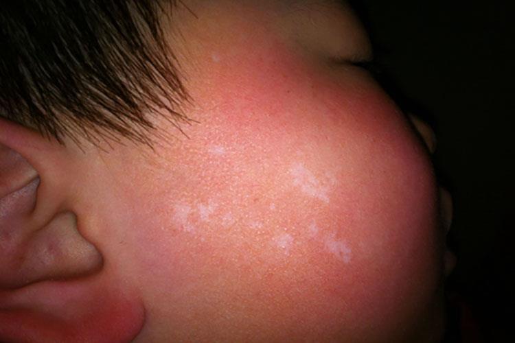 婴儿轻度白癜风图 婴儿轻度白癜风图