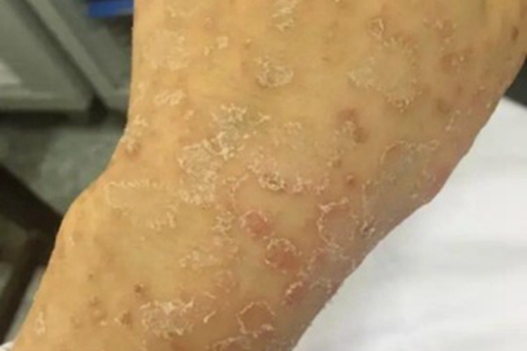 玫瑰糠疹手背脱屑皮肤粗糙图