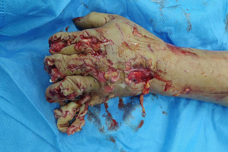 手被机器压伤严重图