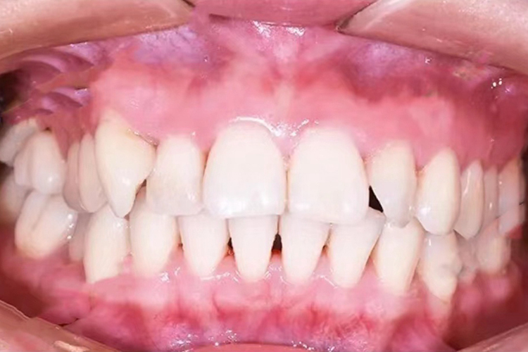 中度牙列拥挤图 中度牙列拥挤图