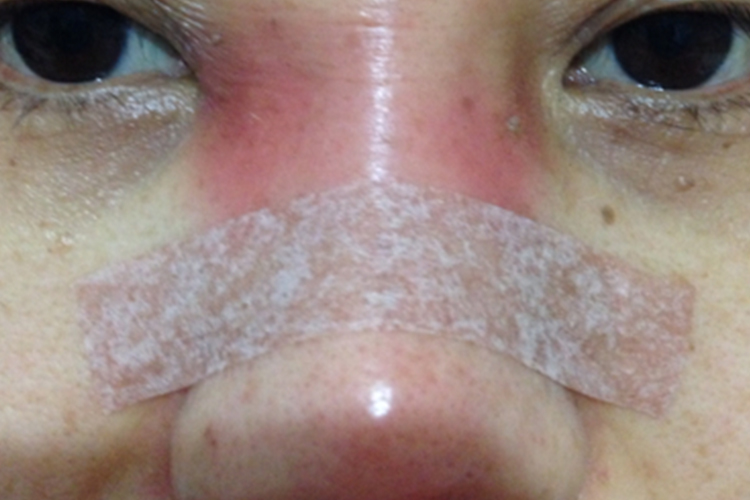 隆鼻后山根红肿图