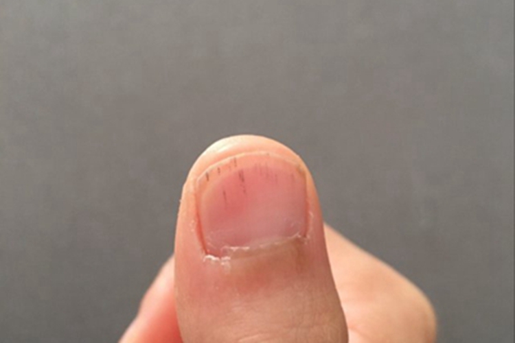 旋毛虫病手指甲症状图