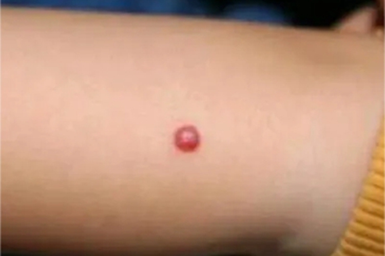 肉芽肿型血管瘤胳膊症状图