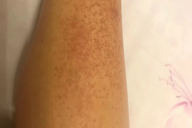 血栓性血小板减少性紫癜红点图 血栓性血小板减少性紫癜红点图