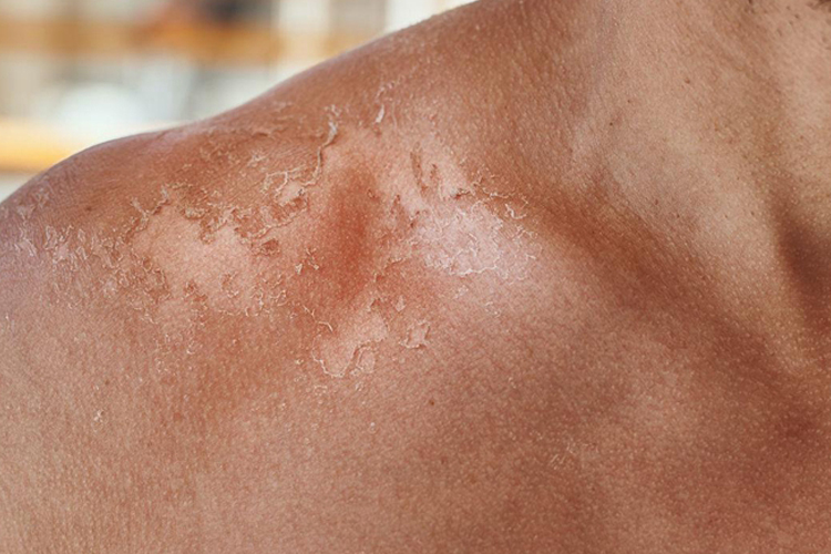 日光性皮炎肩部脱皮图