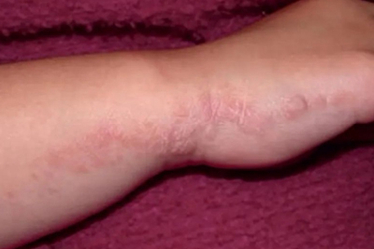 线状苔藓红斑图