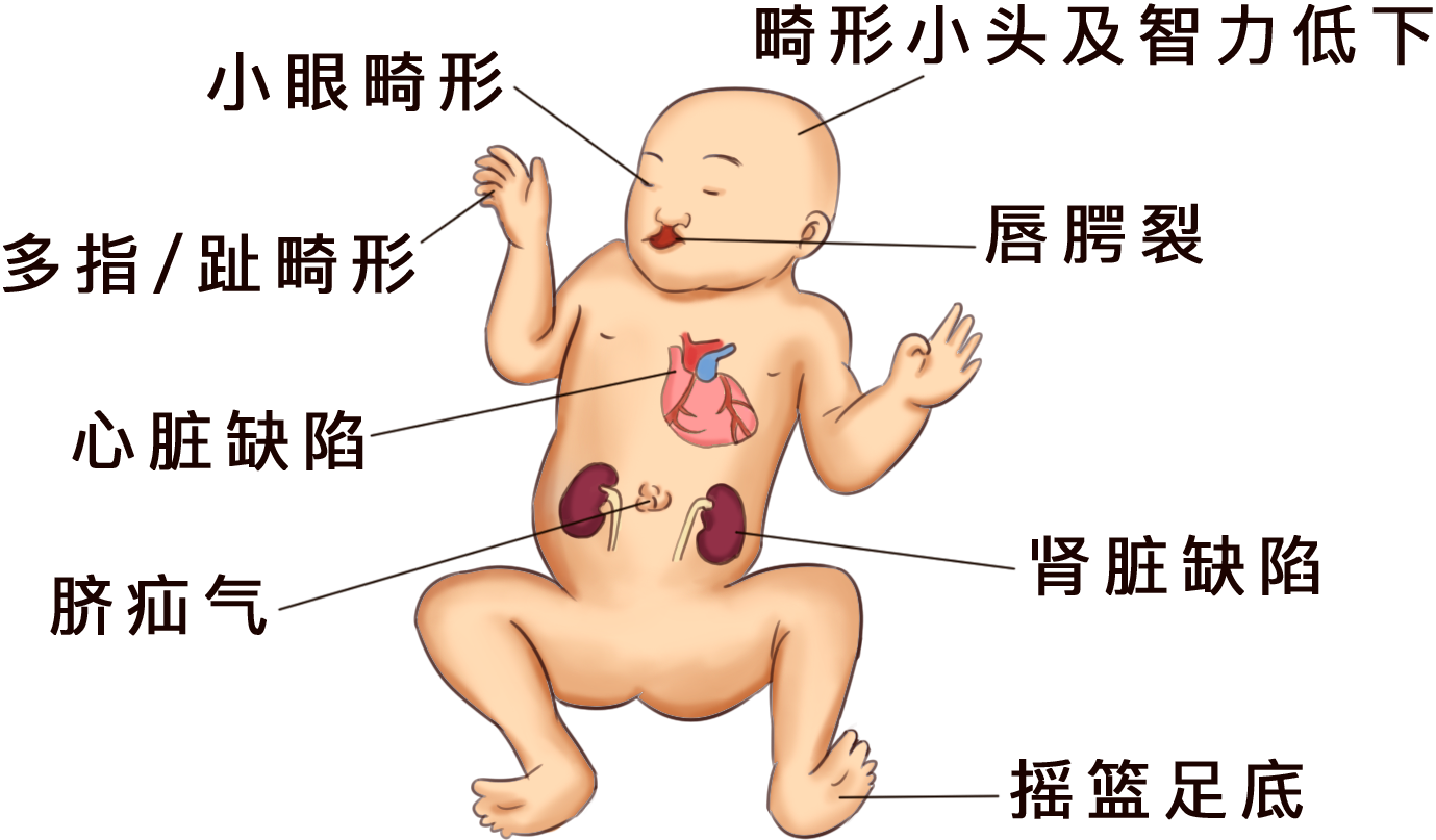 帕陶氏综合征孩子图片_有来医生