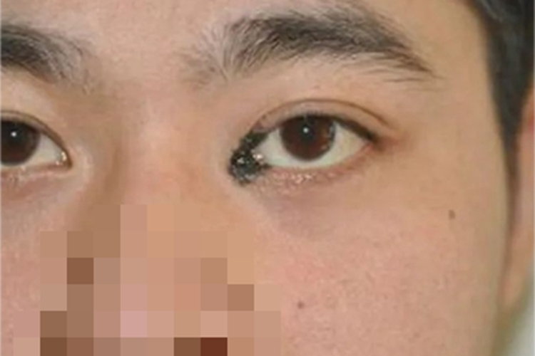 眼睑皮内痣眼角症状图 眼睑皮内痣眼角症状图