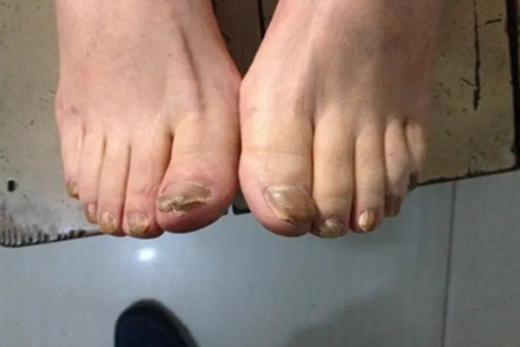 先天性脚趾甲增厚症状图