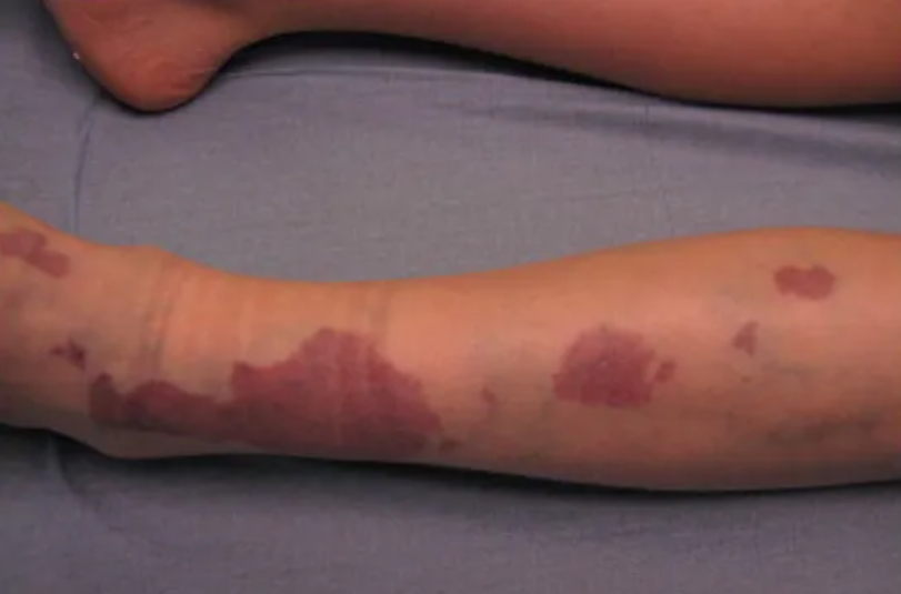 轻度KT综合征图 轻度KT综合征图