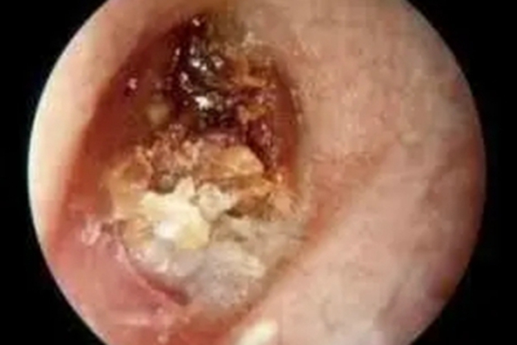 外耳道耵聍栓塞症状图