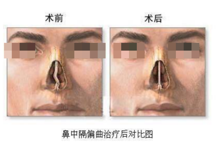 鼻中隔偏曲治疗前后对比图 鼻中隔偏曲治疗前后对比图