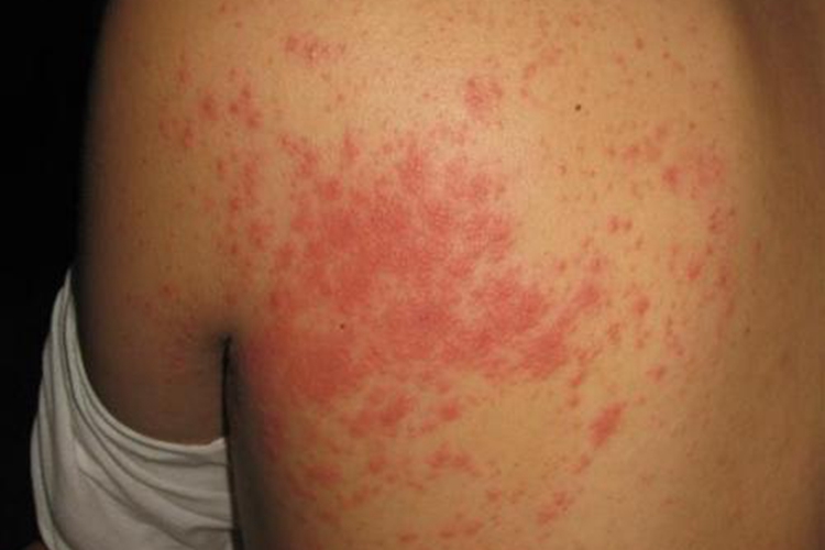 背上螨虫皮炎图